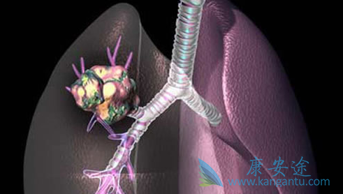 晚期肺癌能治吗 晚期肺癌能治吗