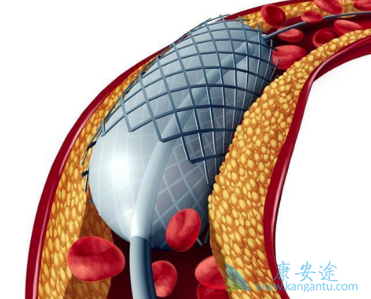 心脏支架手术的寿命 心脏支架手术的寿命