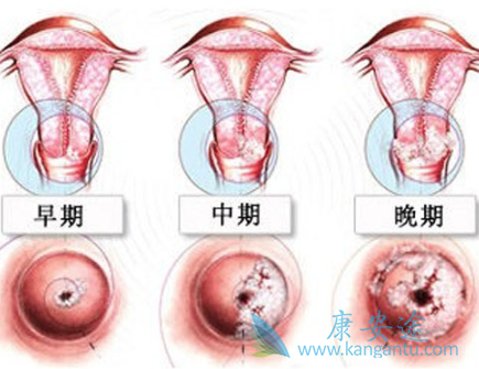 子宫癌症状 子宫癌症状