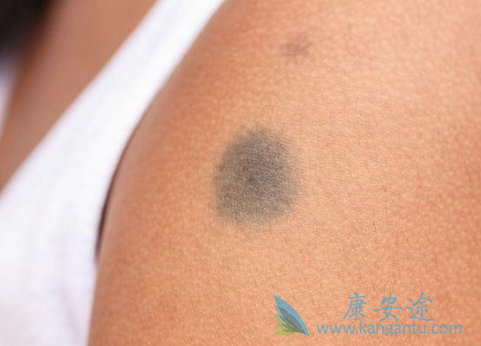 皮肤癌症状 皮肤癌症状