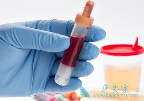 膀胱癌症状 膀胱癌症状