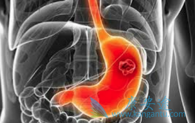 贲门癌症状 贲门癌症状