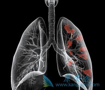 肺癌 肺癌