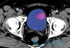 PD-L1���Ƽ�Tecentriq����Ч�ԺͰ�ȫ�Եõ����ٴ���֤