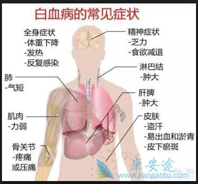 白血病的早期症状 白血病的早期症状