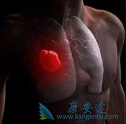 ��������(AFATINIB)����������T790M���Էΰ����ߵ�����Է���