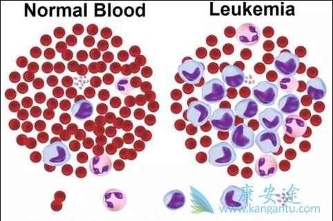 白血病 白血病