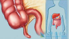 ��������(Capecitabine)���ձ�III�ڽ�ֱ�������ߵı�׼���Ʒ���