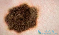 ��ķ����(pembrolizumab)����ƥ�������������������