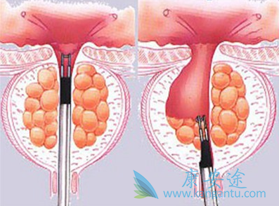 癌症转移 癌症转移