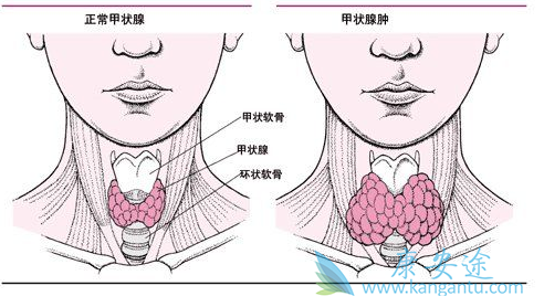 甲状腺癌症状 甲状腺癌症状