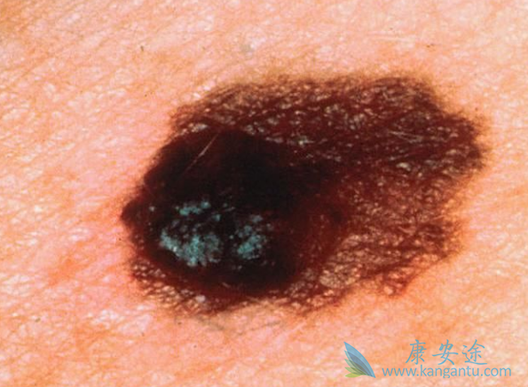 皮肤癌症状 皮肤癌症状