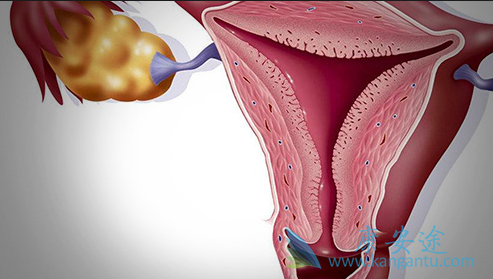 子宫癌症状 子宫癌症状