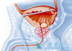 ǰ���ٰ����߳԰�������(Zytiga)����Ѫѹ������ô����