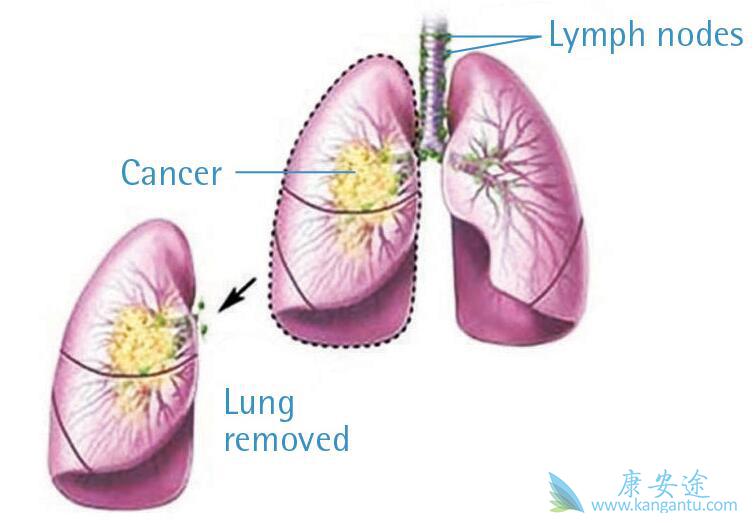 小细胞肺癌 小细胞肺癌