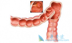 ������(REGORAFENIB)������ʹ�᳦�����߻���˸�����λ����ʱ��