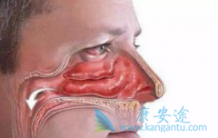 ���ʰ����������ڼ����Ԥ����ǻ��Ѫ