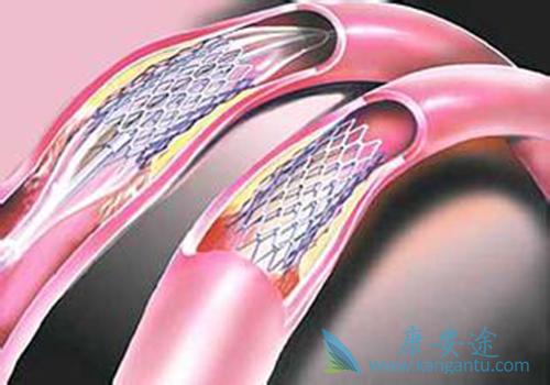 心脏支架 心脏支架