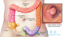 SNPs����ɳ��(Eloxatin)/��ɳ�����������ƽ᳦��������OXPN���