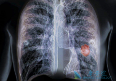 ̵�д�Ѫ��ʲô���£�̵�д�Ѫ�Ƿΰ�����֢״��