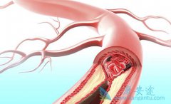 ���Ǹ����Ԥ�����ǶȰ����������Ѫ˨����?