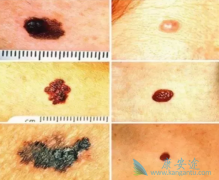 �ٴ��Ϻ�����ɺ�ɫ��������֢״����Щ����