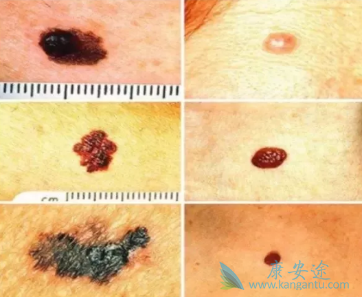 ��ɫ��������֢״