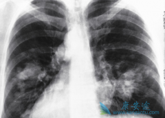 �ΰ�ҩ�Ｊ������(GEFITINIB)�Էΰ����ߵ����߹����и�������