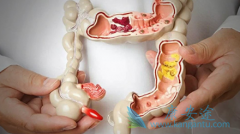 Atezolizumab(Tecentriq)����Cotellic����mCRC���ֽ�չ����