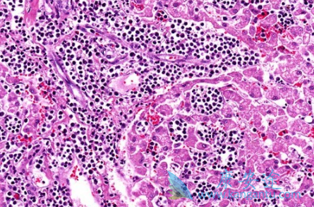 ��Ѫ����Ⱦ��