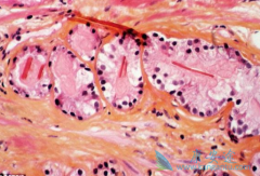 �ȿ�³��(Casodex)���ƽ�չ��ǰ���ٰ����߿�ѡ��Xtandi