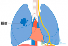 ��ϣ����(Osimertinib)��־���ҹ��ΰ�������ʽ����ȫ�̰�������ʱ��