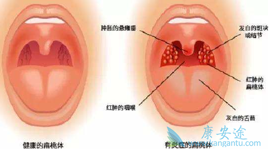 扁桃体癌 扁桃体癌