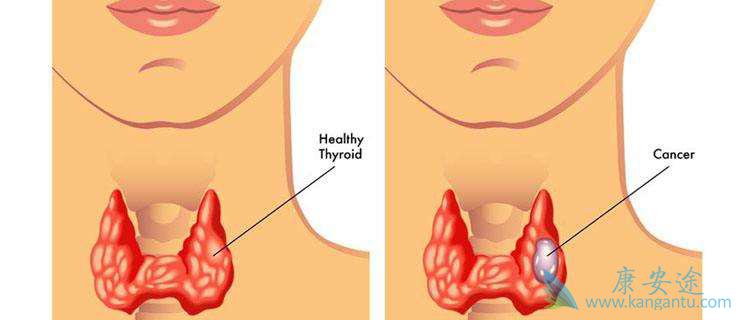甲状腺肿块 甲状腺肿块