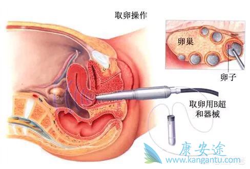 试管婴儿 试管婴儿
