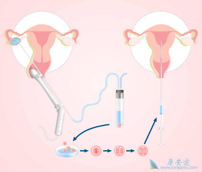 试管婴儿移植后注意事项 试管婴儿移植后注意事项