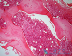 ��ϣ��(Nilotinib)����������������Ѫ������Ӧ����δ���