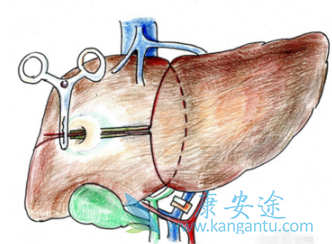 索拉非尼 索拉非尼