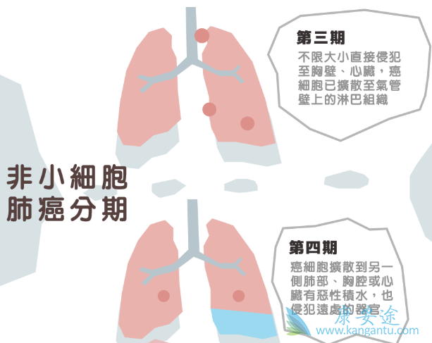 非小细胞肺癌 非小细胞肺癌