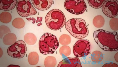 ������(Imatinib)�����ڼ仼����Ҫ�����Щ��Ŀ������ʲôʱ����