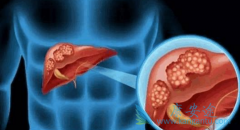 ��������(Inlyta)����TACE�������Ƹΰ����������VEGF����