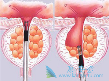 阿比特龙 阿比特龙