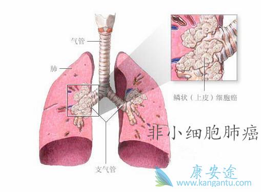非小细胞肺癌 非小细胞肺癌