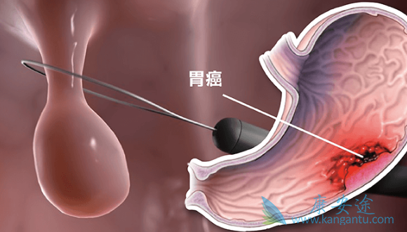 雷莫卢单抗 雷莫卢单抗