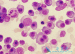 ���ǶȰ�(lenalidomide)������������û�ϸ����Ⱦ��