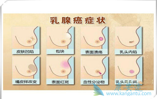 乳腺癌 乳腺癌