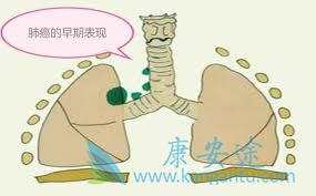 肺癌早期症状 肺癌早期症状