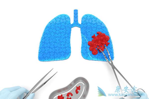肺癌传染吗 肺癌传染吗