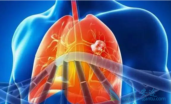肺癌治疗 肺癌治疗