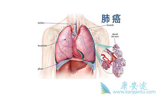肺癌晚期 肺癌晚期